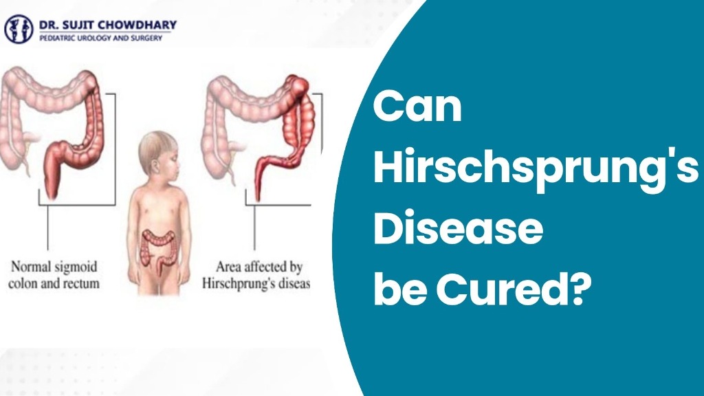 Can Hirschsprung's Disease be Cured?