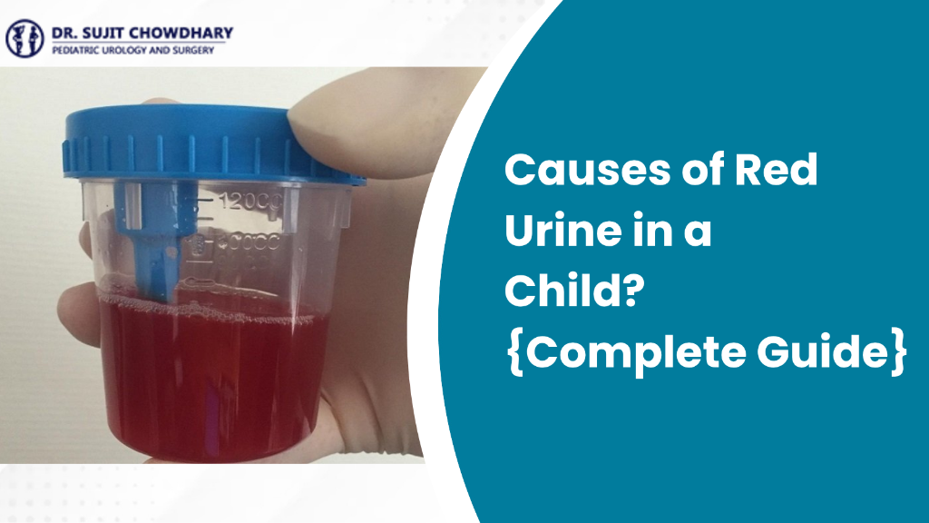 Causes of Red Urine in a Child Complete Guide - Sample Container of Red Urine