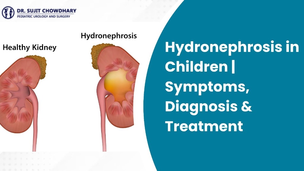 Hydronephrosis in Children Symptoms, Diagnosis & Treatment - Healthy Kidney vs Hydronephrosis Diagram