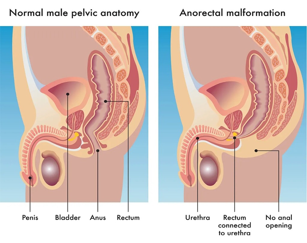 Anorectal Malformation Pelvic Anatomy Diagram