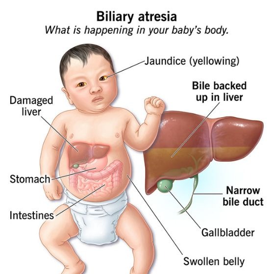 Biliary Atresia Medical Diagram