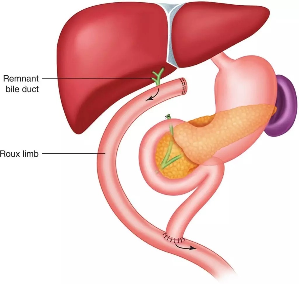 Choledochal Cyst Biliary Reconstruction Diagram