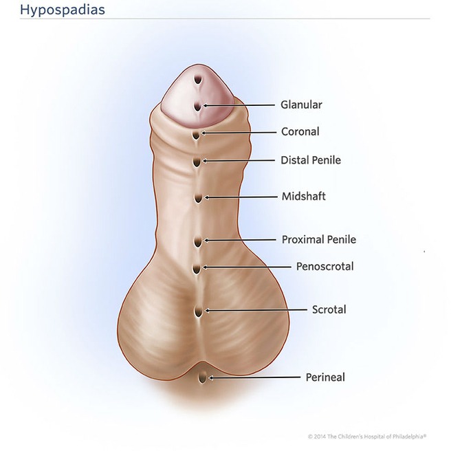 Hypospadias Medical Classification Diagram