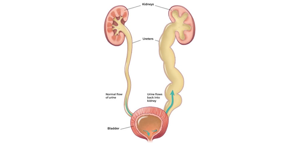 Vesicoureteric Reflux Medical Diagram
