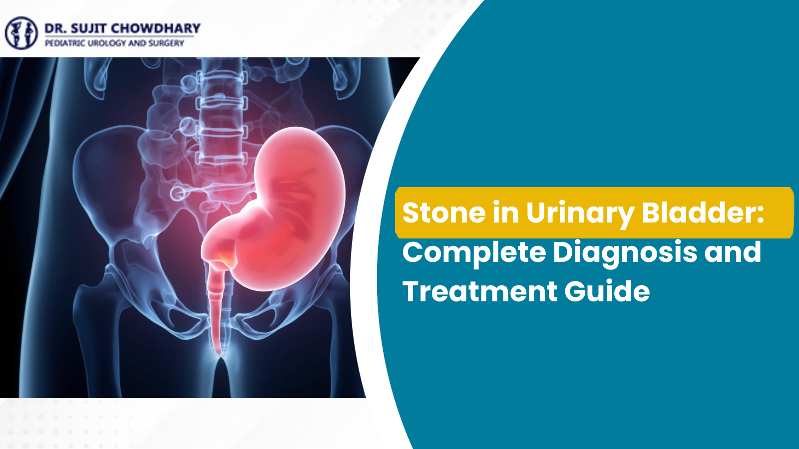 Stone in Urinary Bladder showing bladder anatomy and stone location explained by paediatric urologist